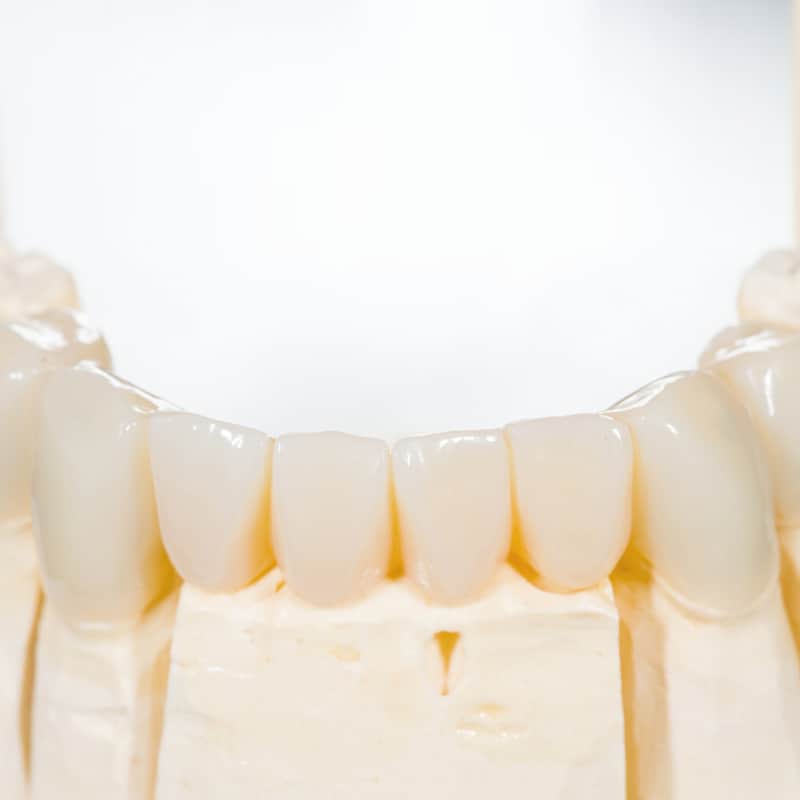 all ceramic porcelain restorations in North Naples