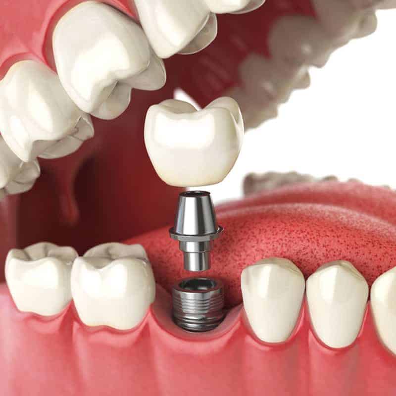 dental implants near you