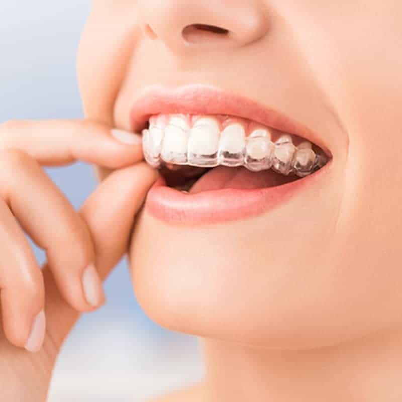 Invisalign in North Naples, FL