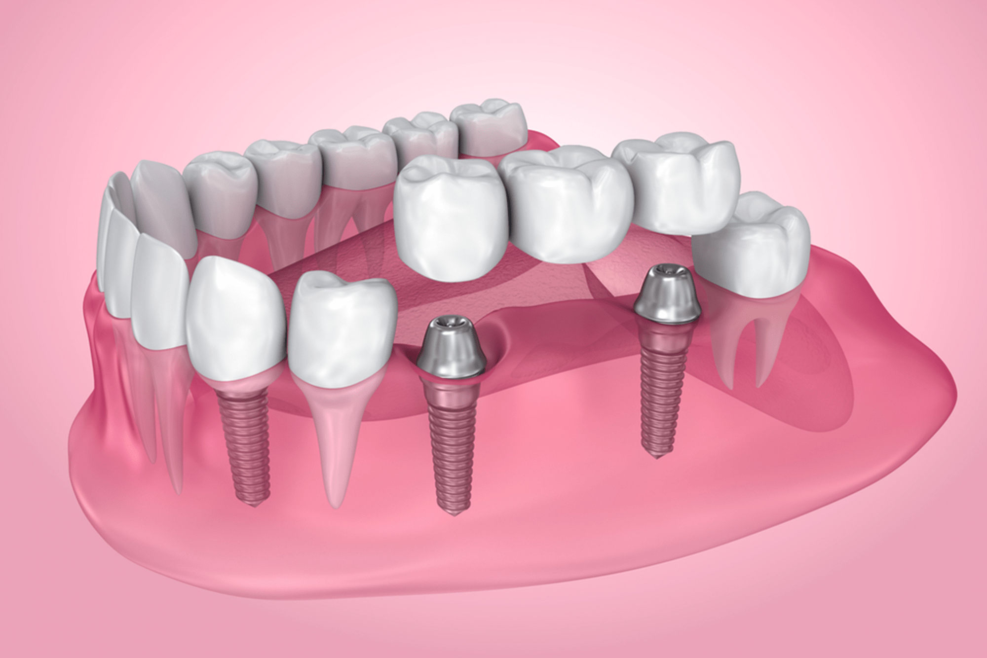 the-biggest-problem-with-dental-implants-and-their-solutions