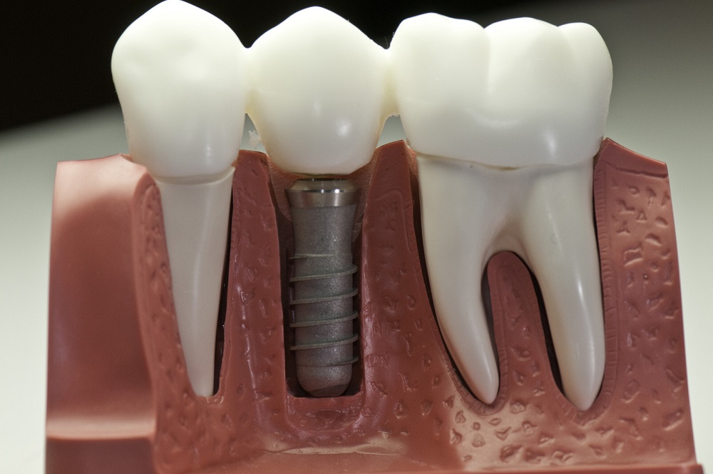 dental implant structure