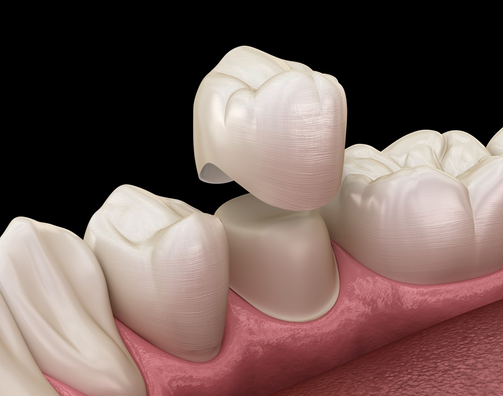 dental crowns near me