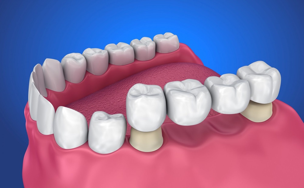 dental bridges near you