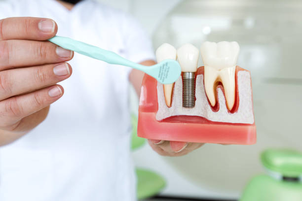 smile makeovers with dental implants