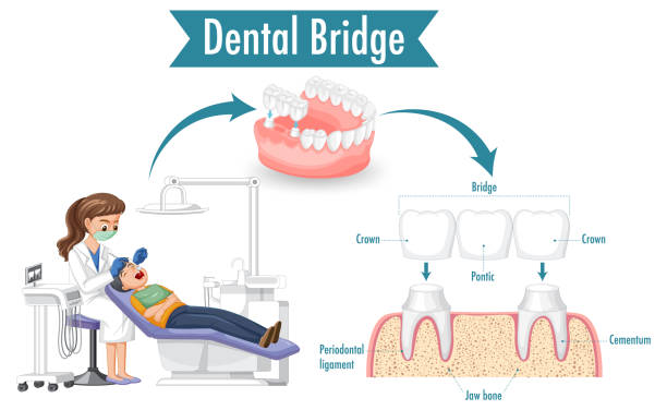 benefits of dental bridges restore your smile and function