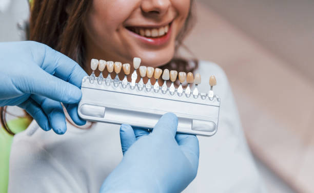 what to know before getting porcelain veneers