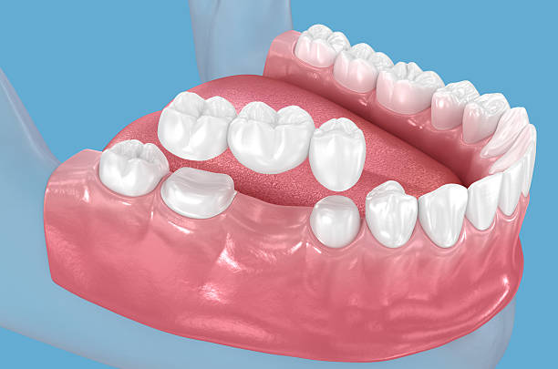 benefits of replacing missing teeth with dental bridges