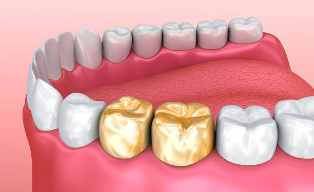 restore your smile with natural looking crowns