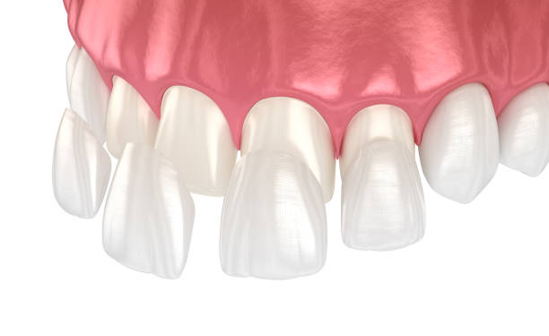 do porcelain veneers damage your natural teeth